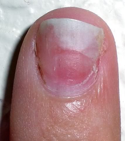 Blood Blister Fingernail